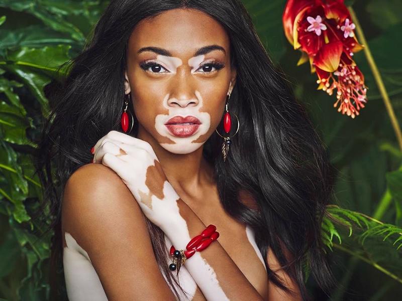 Chantelle Brown-Young, más conocida como Winnie Harlow, desarrolló vitil...